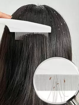 Anti-Dandruff Super Dense Teeth Fine-Tooth Comb, Head Scalp Cleaner, Lice And Nit Removal Tool,Hair Clips,Hair Accessaries offers at $1.62 in SheIn